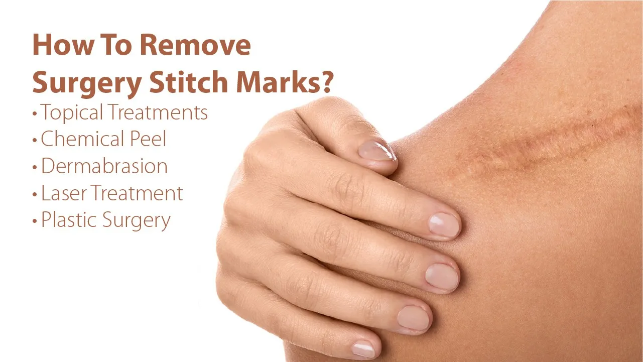 How To Remove Surgery Stitch Marks?