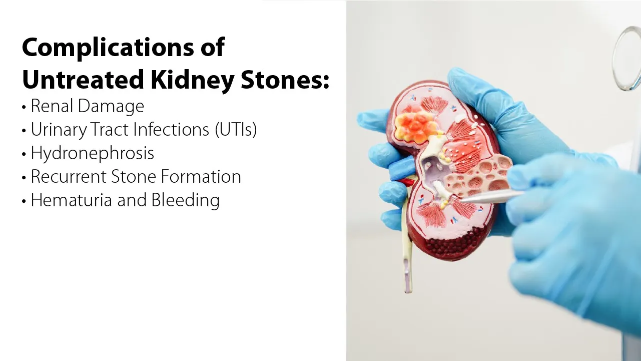 Complications of Untreated Kidney Stones