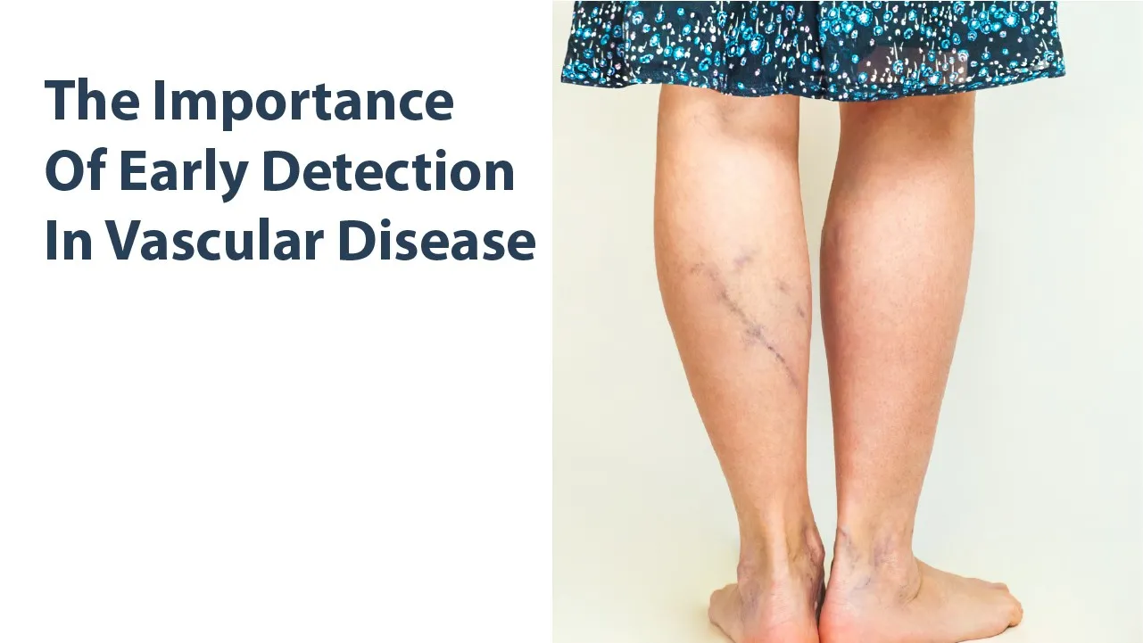 The Importance of Early Detection in Vascular Disease
