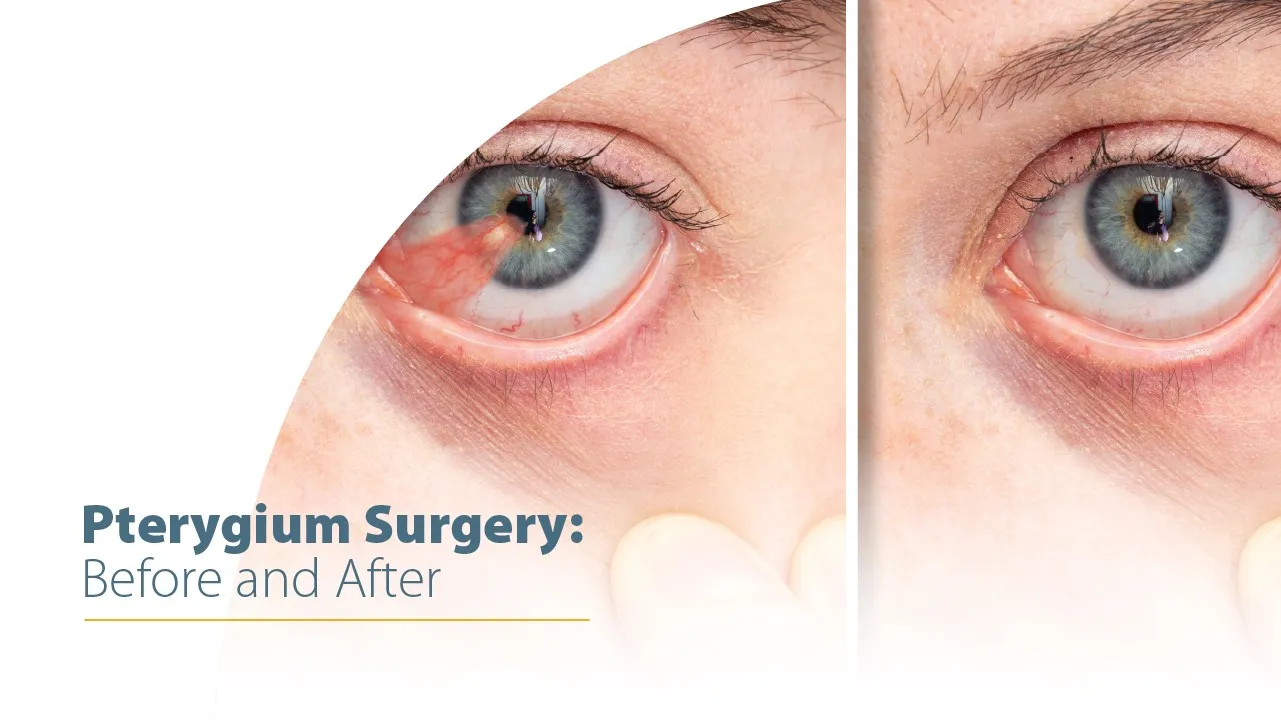 Pterygium Surgery: Before and After