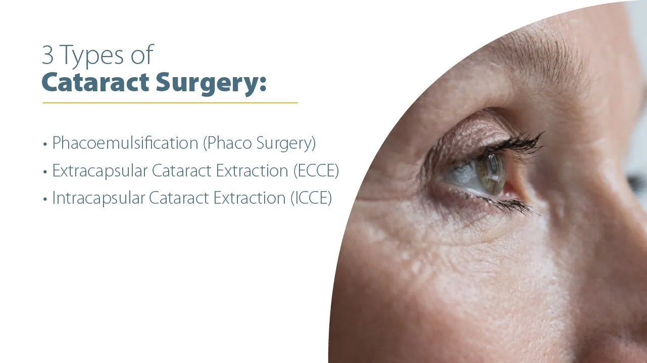 3 Types of Common Cataract Surgery: Choose the Right One