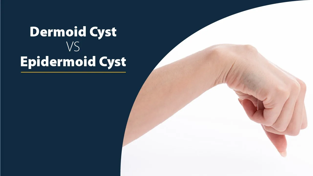 Dermoid Cyst vs Epidermoid Cyst