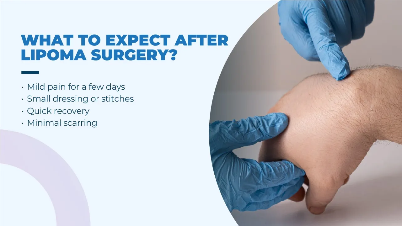 What to Expect in Lipoma Surgery?