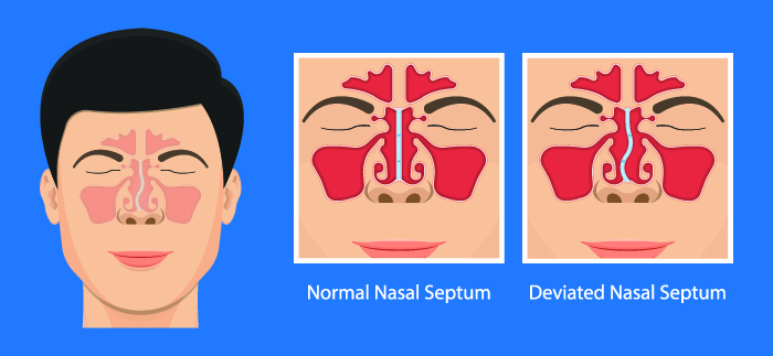 Deviated septum store snoring