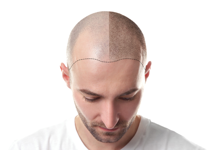 Best Hair Transplant Clinic in India  Hair Transplant Cost  New Roots Hair  Clinic