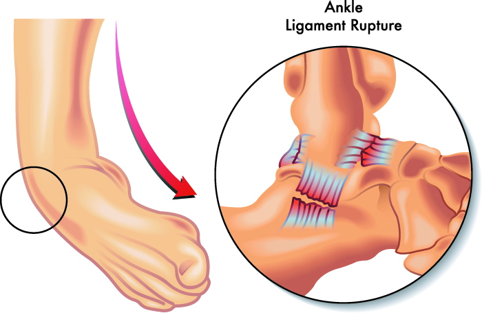 Ankle Replacement Surgery | Surgical Treatment Options | Exactech