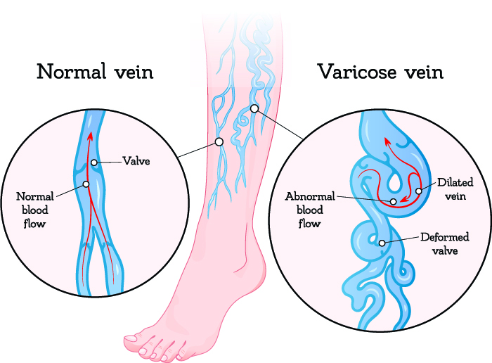 Varicose Veins Treatment in Kondapur, Hyderabad