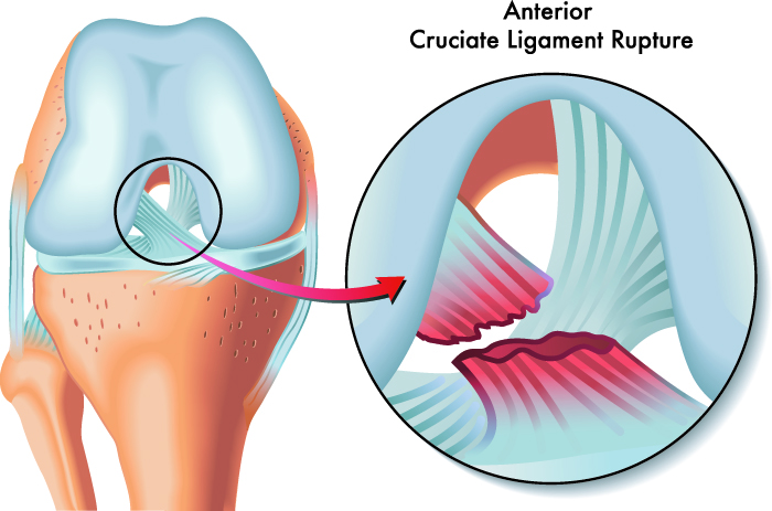 Ligament Injury, Rupture, and Tear Treatment in Thane