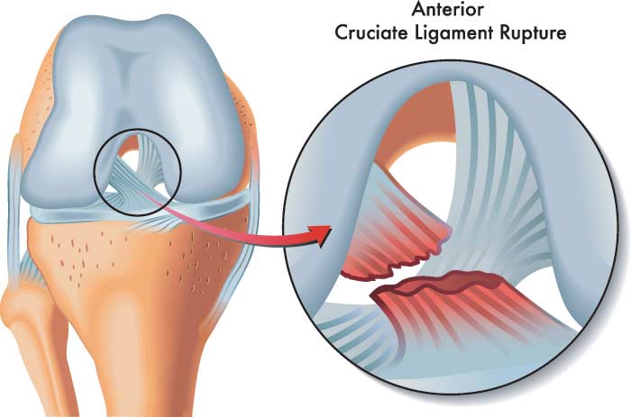 Ligament Injury, Rupture, and Tear Treatment in Thane