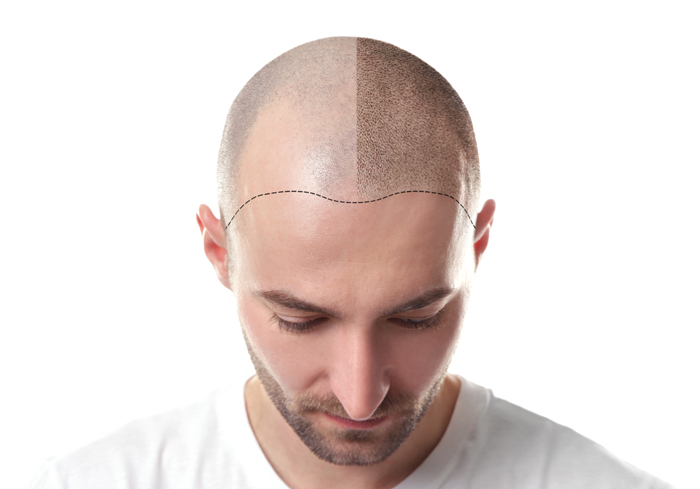 Do hair transplants work Types side effects and recovery