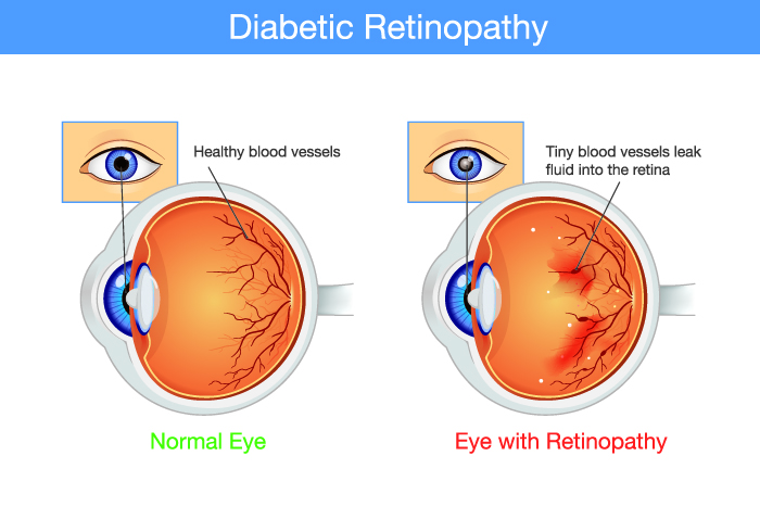 Types of Retinal Detachment, Their Causes, and Treatments