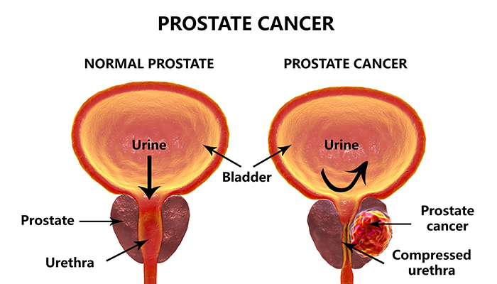 Prostate Cancer- Symptoms, Causes, & Treatment?