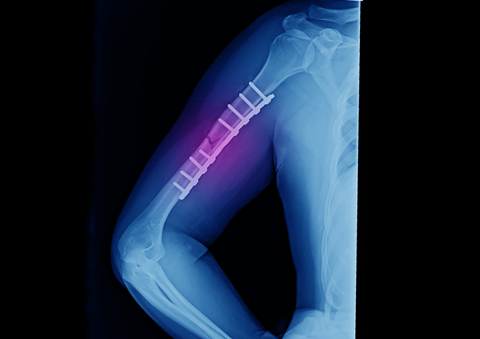 Ligament Tear Treatment in Kondapur, Hyderabad